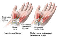 Not carpal tunnel